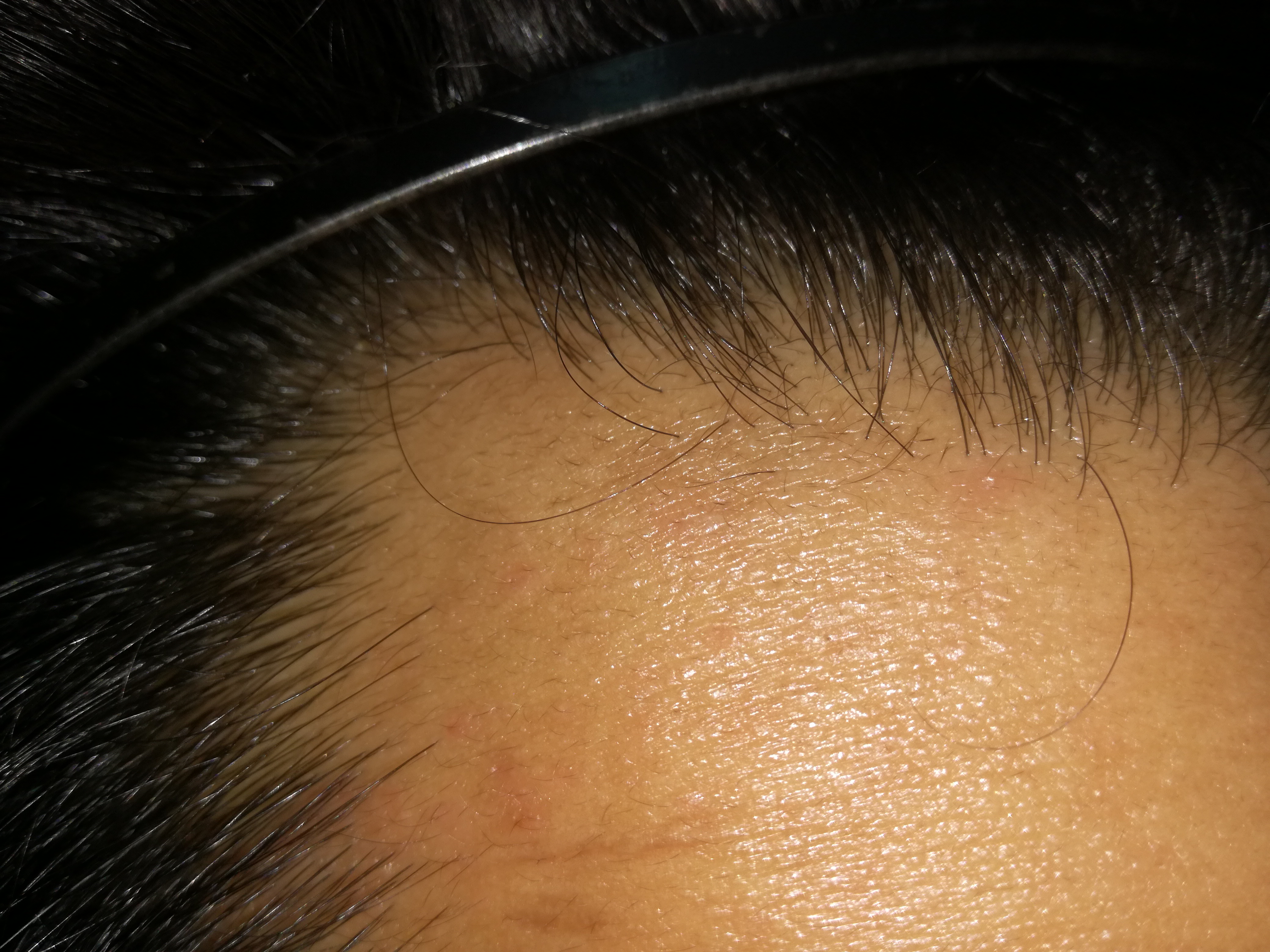 ᐅᐅᐅ Hair Growth Serum That Works Proof With Pictures Click On These Pictures And Examine Hairline To See New Hairs